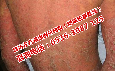 男性牛皮癣患者如何护理