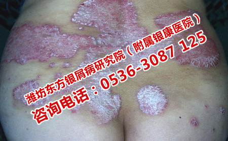 治疗牛皮癣的有效法方法