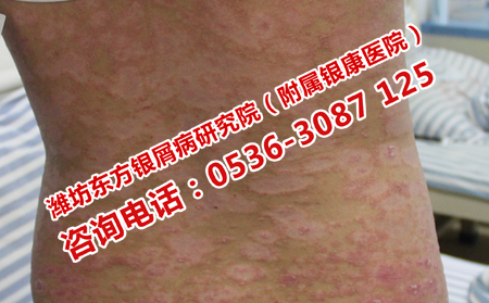 世界银屑病日关注银屑病