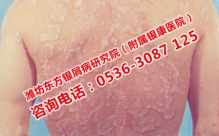 牛皮癣治疗中的常见错误