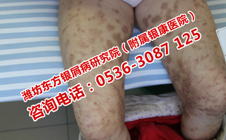 治牛皮癣的其他方