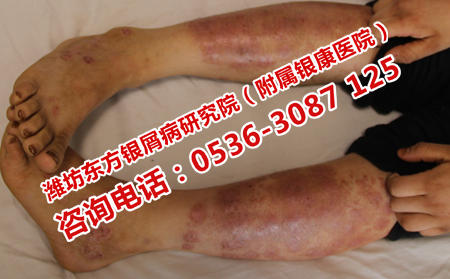 银屑病治疗专科医院