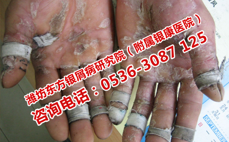 去哪里诊断牛皮癣减少误诊