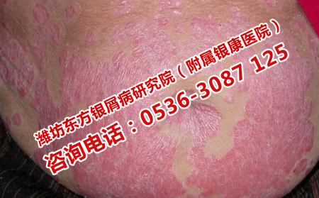 顽固牛皮癣的防治方法