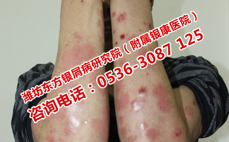 银屑病长期用药的危害