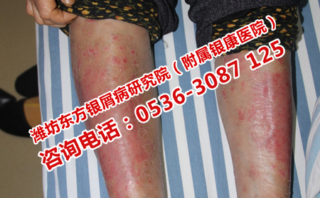 如何诊断银屑病的恢复