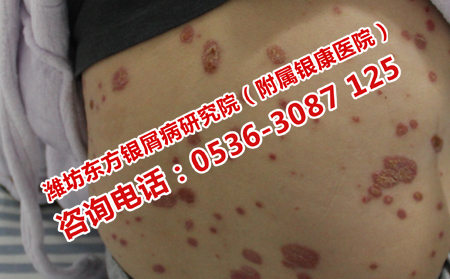 银屑病可以转有什么症状