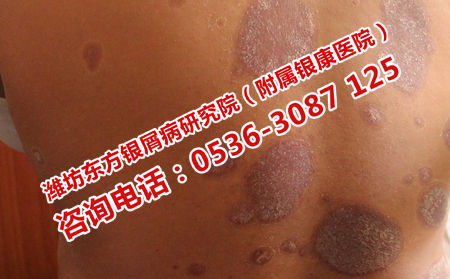 潍坊东方银屑病研究院靠谱吗