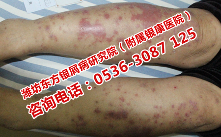 银屑病能有效好的吗