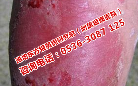 牛皮癣会在怀孕之后加重吗