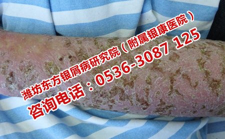 老人如何战胜银屑病