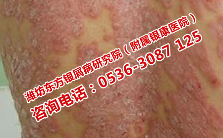如何区分寻常性银屑病和红皮型银屑病