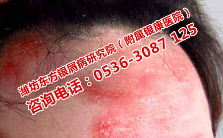 潍坊东方银屑病研究院是正规医院吗