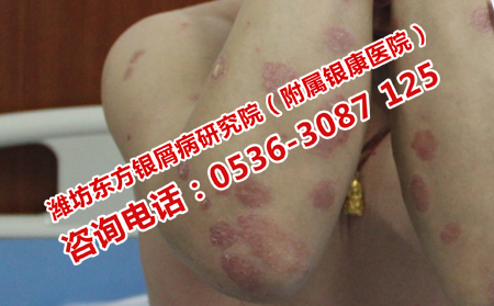 银屑病照光治疗的效果