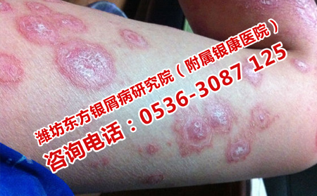 银屑病恢复过程中的症状