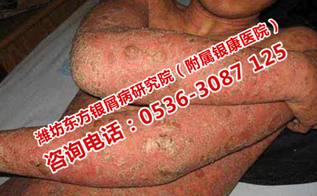 银屑病伴发疾病的诊断