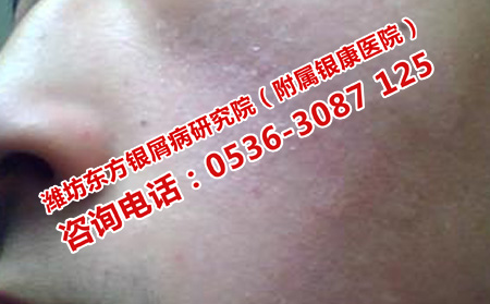 面部银屑病防治办法