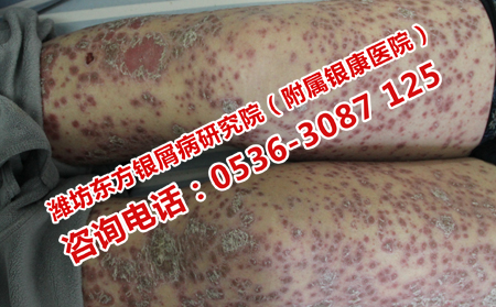 如何诊断脓疱性银屑病