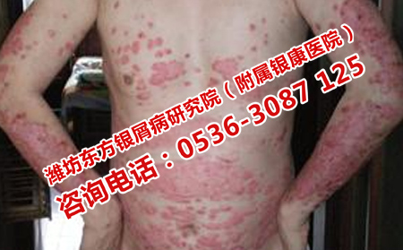 牛皮癣出现新症状的原因