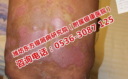 寒亭治疗银屑病