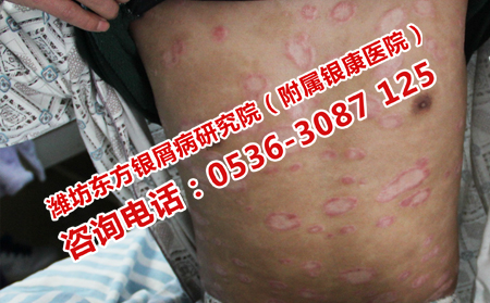 安丘中医治银屑病
