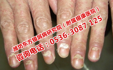 治疗关节型牛皮癣的办法