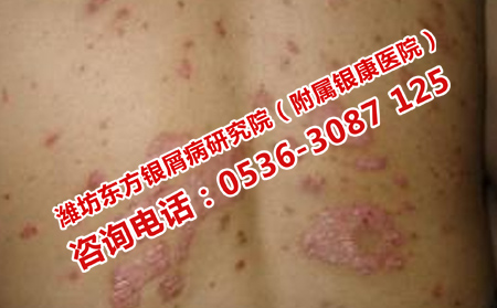 潍坊哪里治银屑病有效