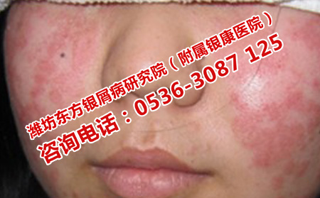 儿童银屑病的伤害
