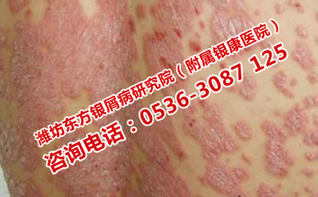 如何诊断银屑病病情的轻重
