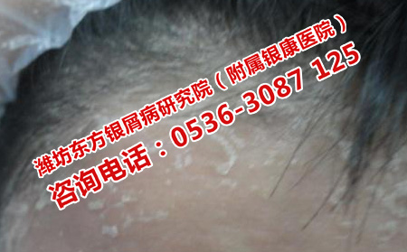 哪里的牛皮癣症状先可以转