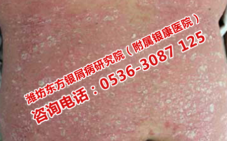 牛皮癣如何治疗更好