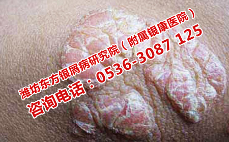 如何避免银屑病的加重