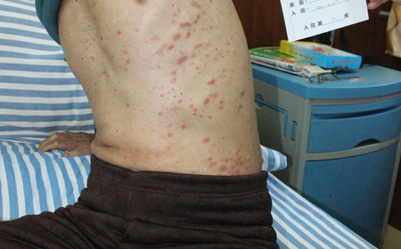 银屑病患者为什么要验血