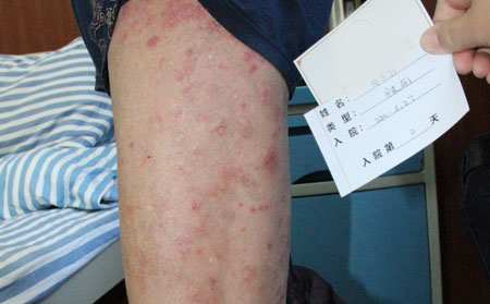 银屑病治治疗效果果可以