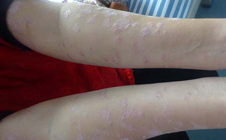 哪些原因使得牛皮癣比较容易复发