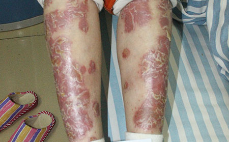 脓疱性银屑病如何治疗呢