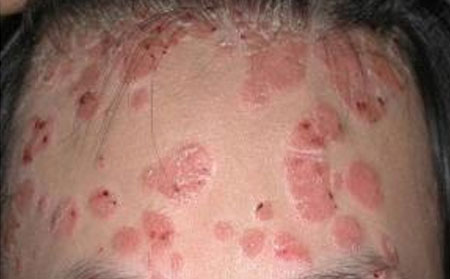 寻常型银屑病治疗药物