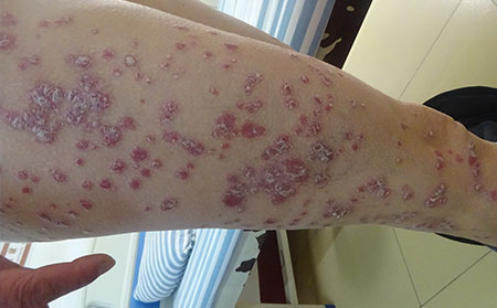银屑病治治疗效果果如何