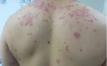 牛皮癣治疗