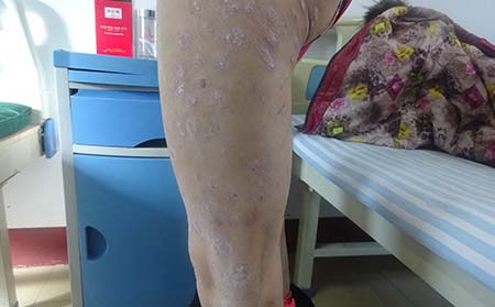 如何治疗女性银屑病