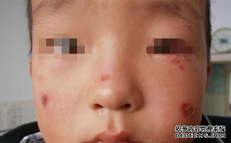 银屑病的护理