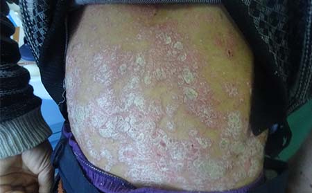 银屑病发生的原因