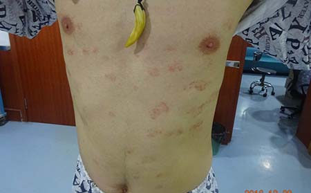银屑病需要心理治疗