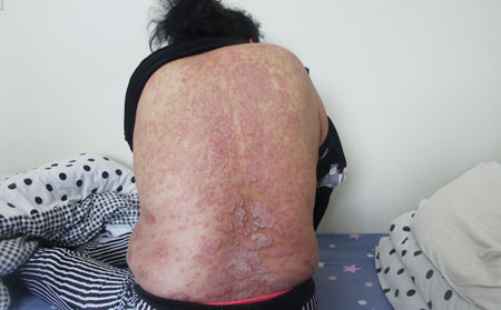 银屑病如何预防复发
