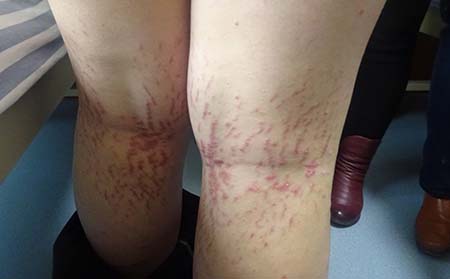 去潍坊东方银屑病研究院治疗好不可以
