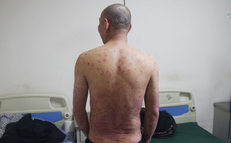 治疗银屑病 患者要警惕三点陷阱