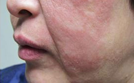 化妆加重银屑病 别把美丽当做借口