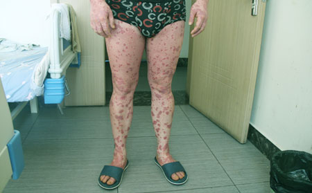 脚部银屑病患者夏天注意什么?