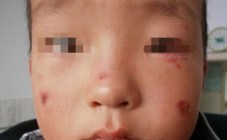点滴状牛皮癣发病有哪些特点呢?