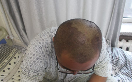 银屑病患者能使用浴霸洗浴吗？